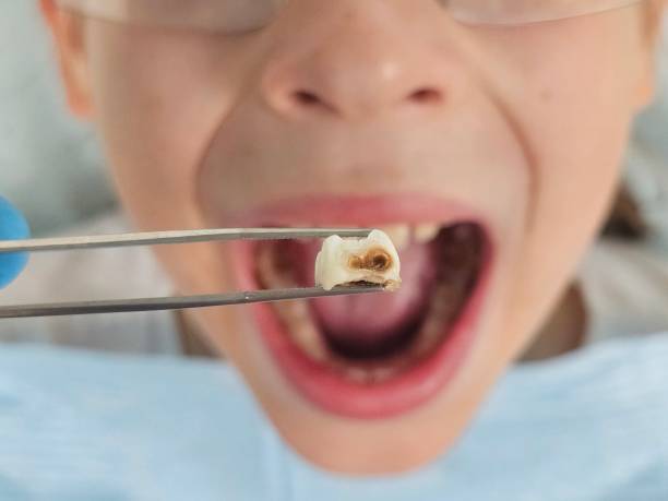 Best Emergency Dental Care for Broken or Chipped Teeth in South Houston, TX